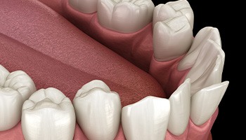 Illustration of crooked teeth