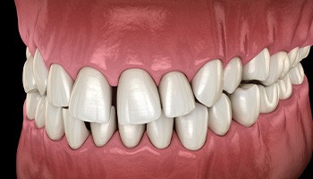 Illustration of gapped teeth