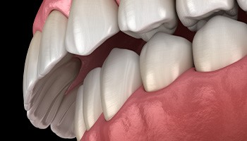 Illustration of an overbite