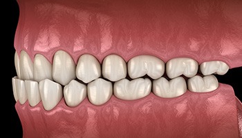 Illustration of an underbite