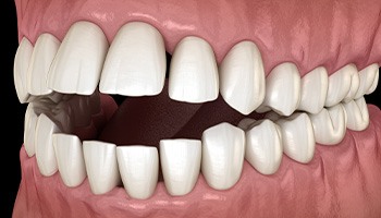 Illustration of an open bite