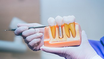 Digital illustration of bone grafting