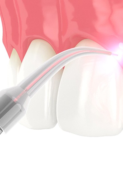 Illustration of laser being used for periodontal therapy